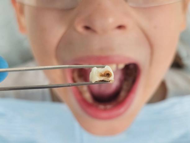 Best Emergency Tooth Extraction in South Run, VA